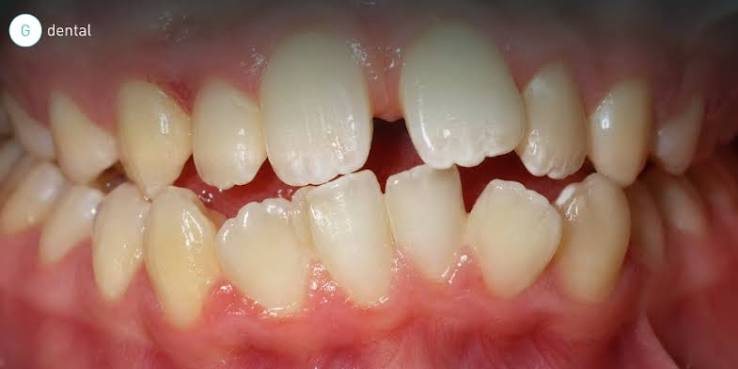 Adult Teeth Straightening in Greensborough: Aligners or Braces?
