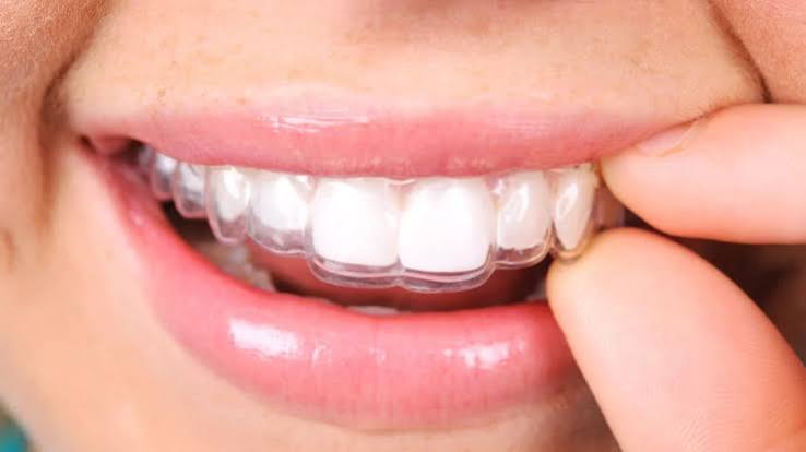 Clear Aligners in Greensborough: Cost Factors and Payment Questions