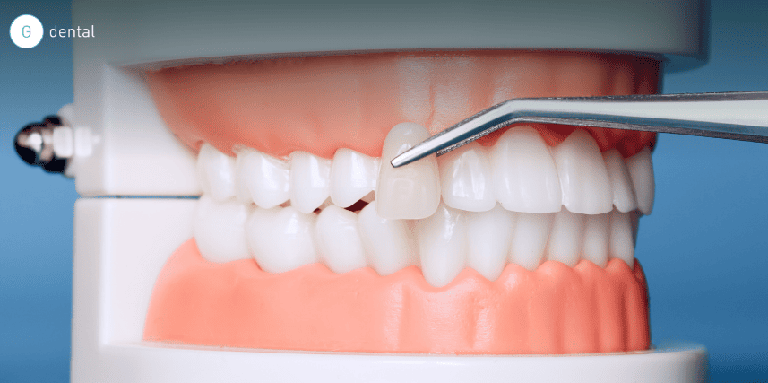 Chipped Veneer: Can It Be Repaired or Does It Need Replacing?